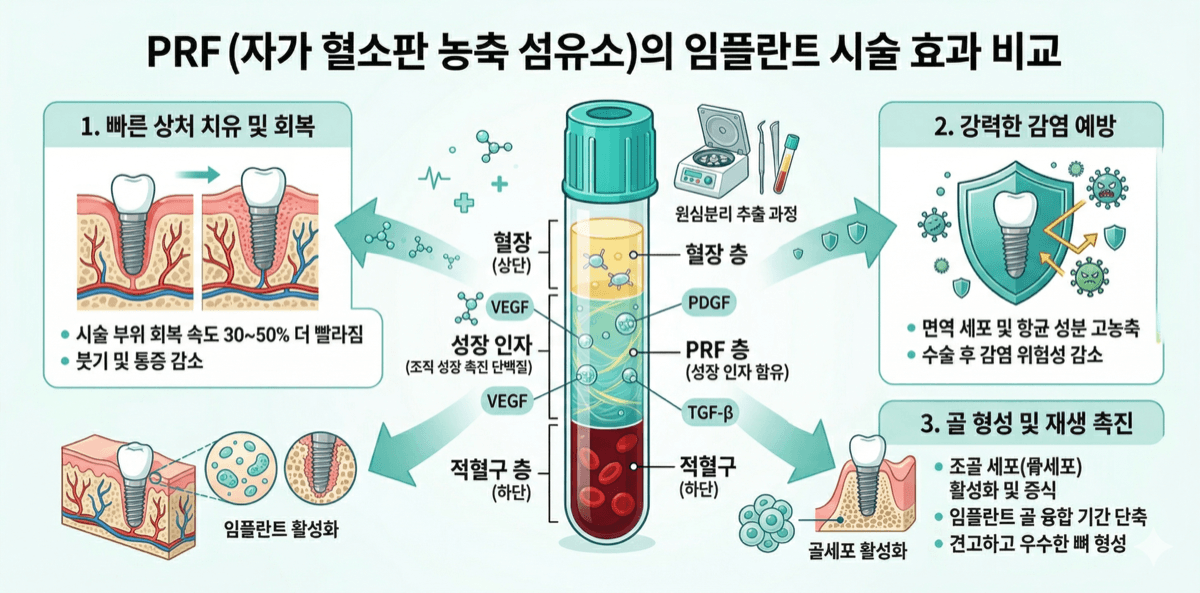 PRF 자가혈 임플란트 효과 비교 인포그래픽
