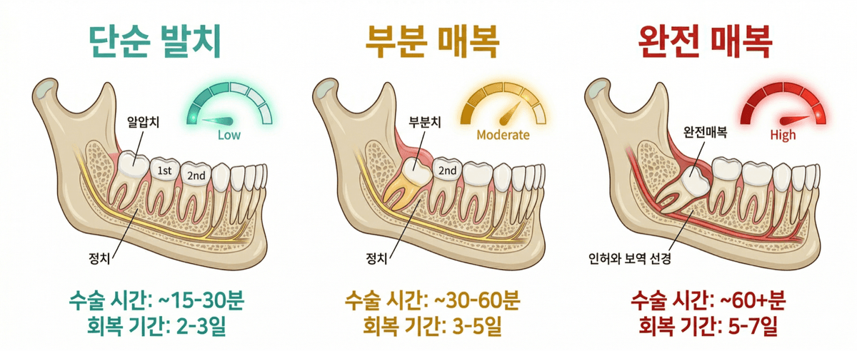 사랑니 발치 난이도별 비교 - 단순/부분매복/완전매복